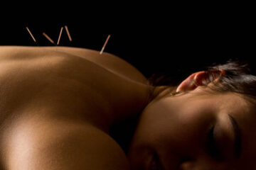 Acupuncture Calgary