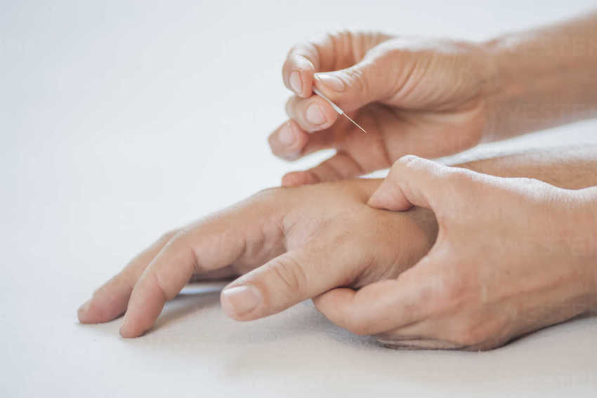 Calgary distal acupuncture